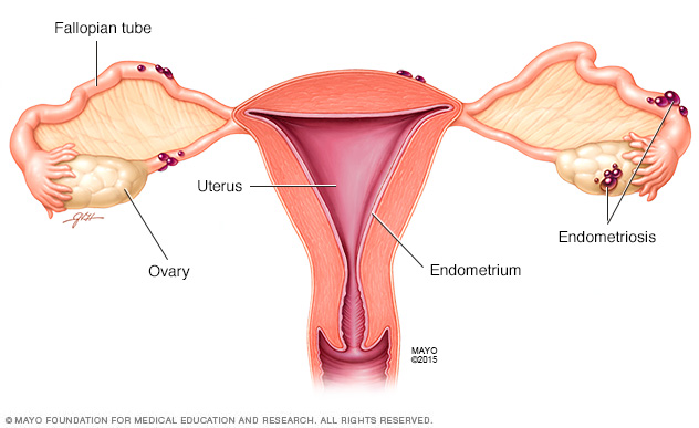 endometriosis diagram via mayo clinic